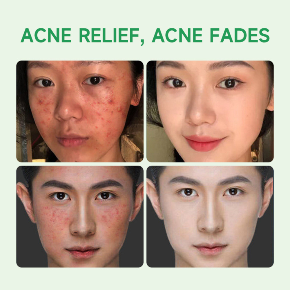 GMEELAN Tea Tree Acne Spot Removal Gel 20g