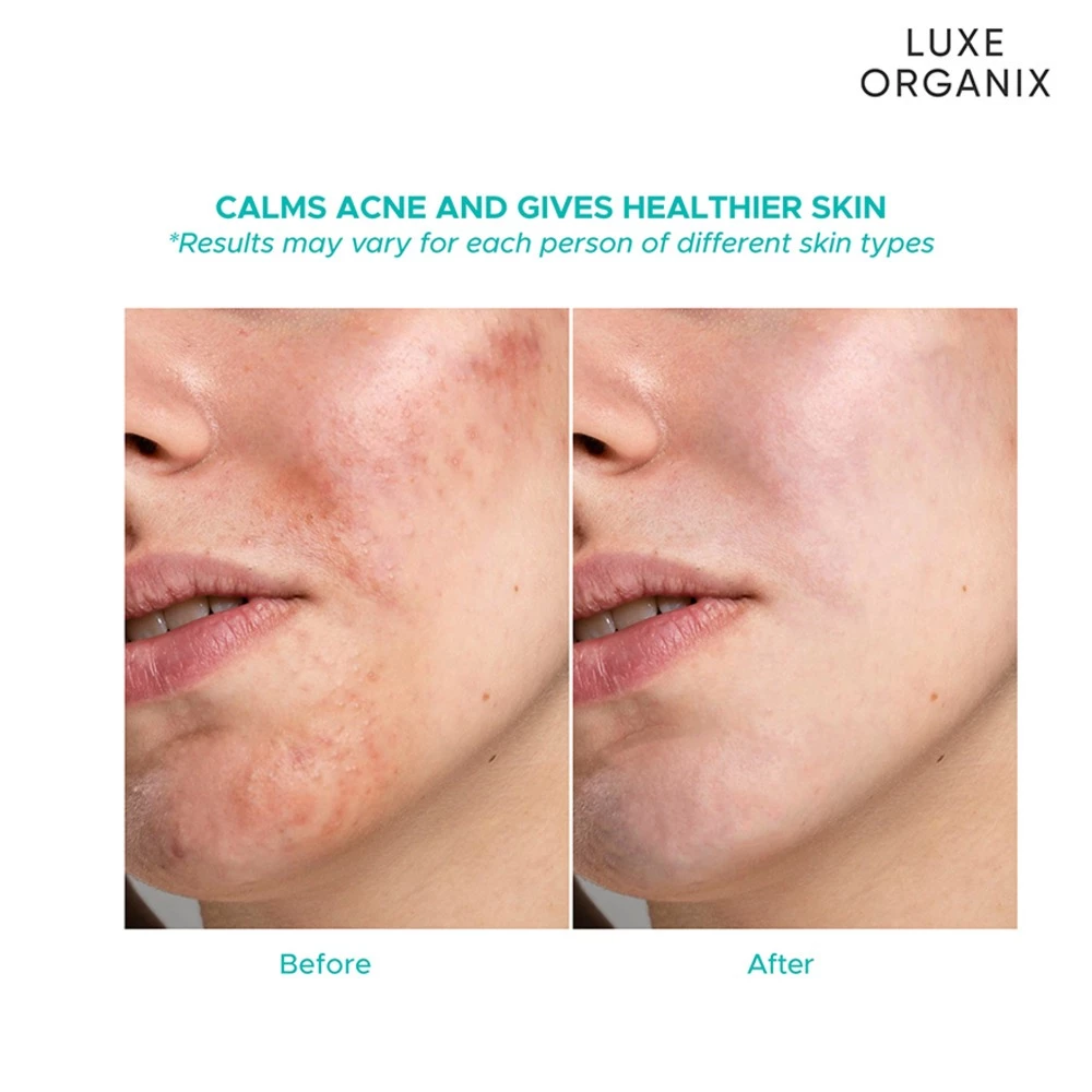 Before and after comparison of skin with Luxe Organix product showing calmed acne and healthier skin.