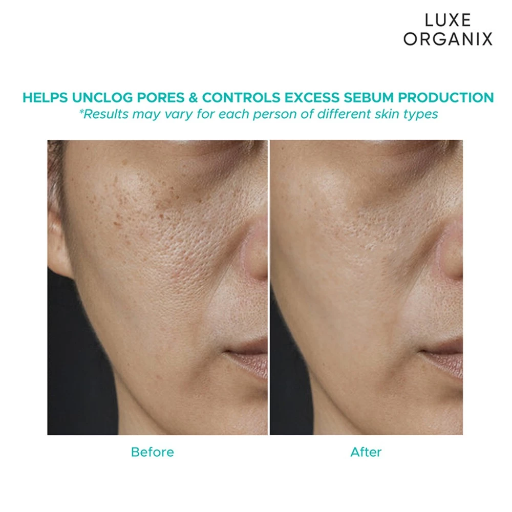 Before and after comparison of skin treatment by Luxe Organix on a person's face. Luxe Organix Miracle Solutions Acne Derm + Serum with Niacinamide and AHA BHA 30ml