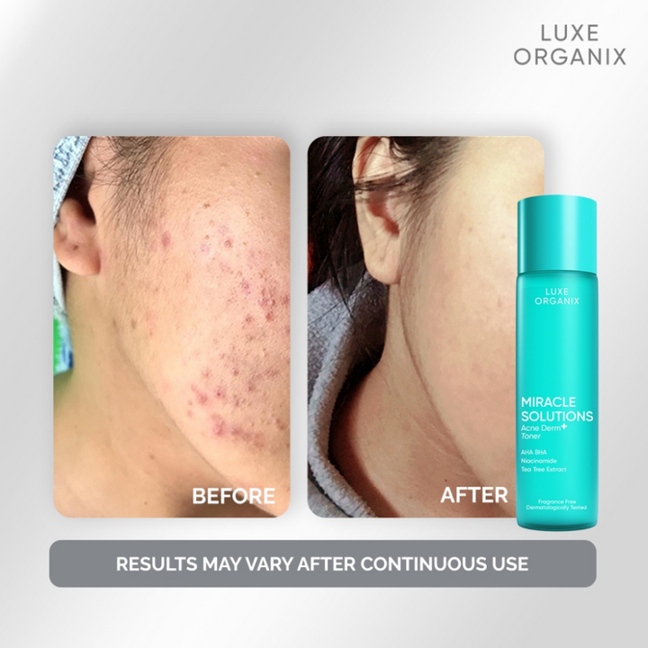 Luxe Organix Miracle Solutions AHA/BHA Tea Tree Pore Clarifying Treatment Toner 150ml