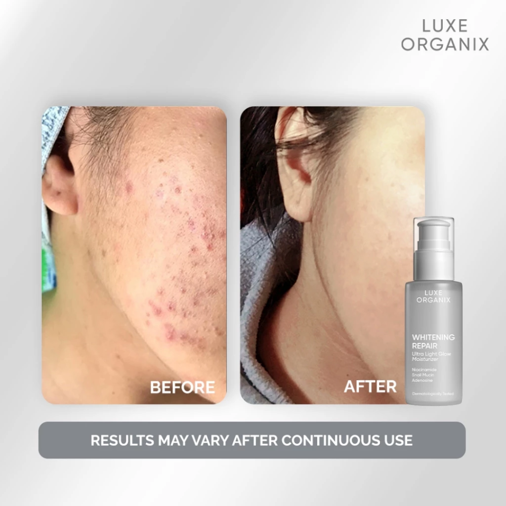 Before and after comparison of skin with Luxe Organix skincare product. Luxe Organix Whitening Repair Ultra Light Glow Moisturizer 80ml
