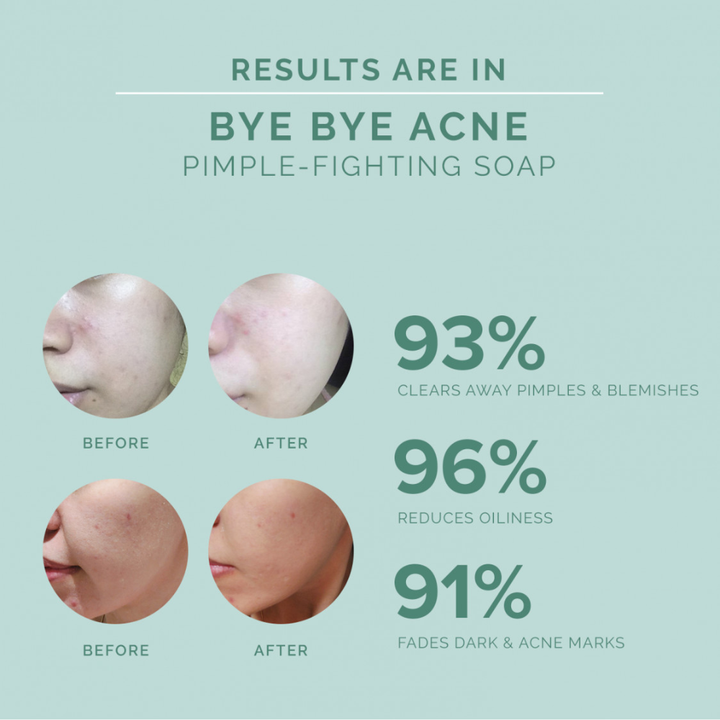 Seoul White Korea Bye Bye Acne Bright & Clear Pimple-fighting Soap